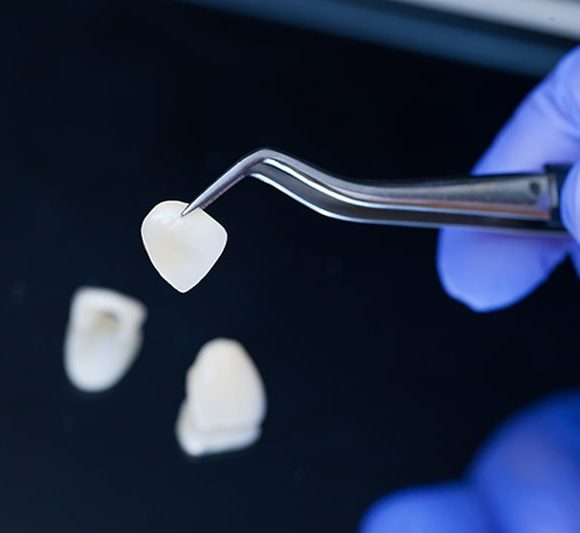 Veener | Faccette Dentali