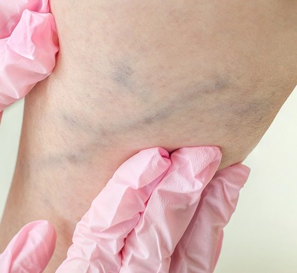 Lesioni vascolari corpo e gambe