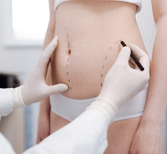 Liposuzione – Liposcultura