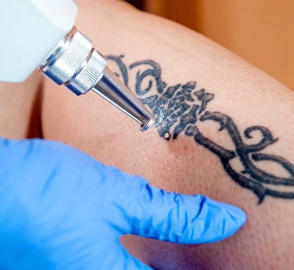 Rimozione tatuaggi
